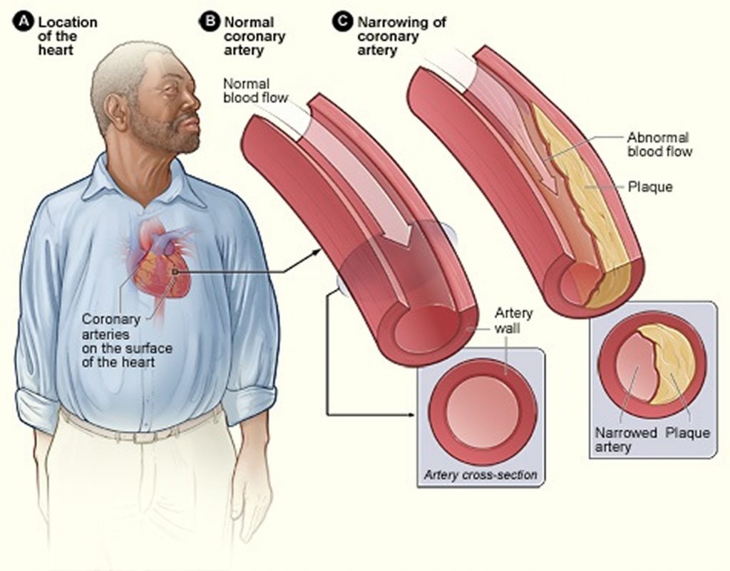 Clogged Arteries Causes Symptoms Signs Treatment And Prevention