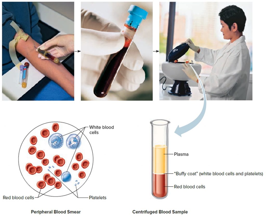 Hematocrit Normal Range Levels Causes Of Low Or High Hematocrit