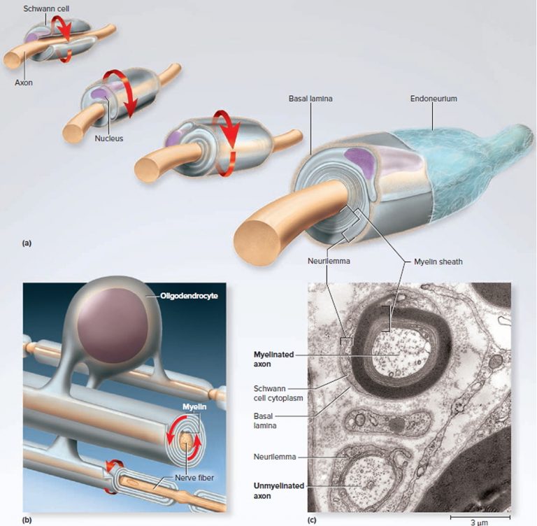 Schwannoma Causes Symptoms Diagnosis Treatment