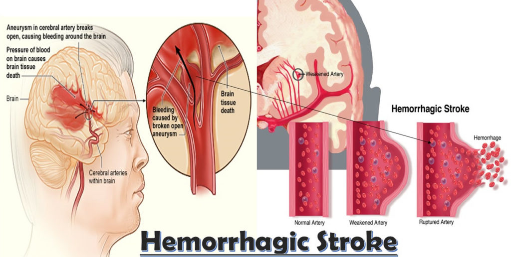 Intracerebral Hemorrhage Causes Symptoms Diagnosis Treatment Recovery