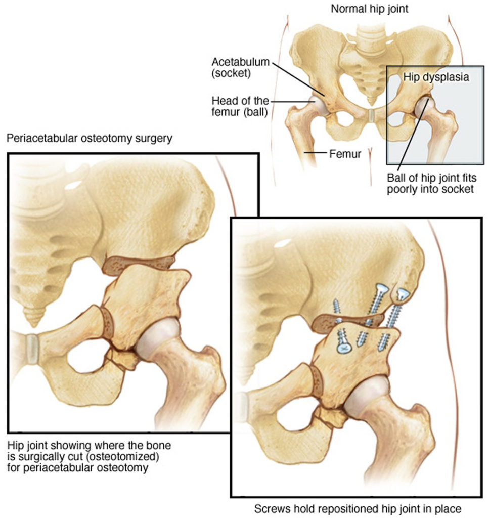 Остеотомия дисплазия тазобедренного