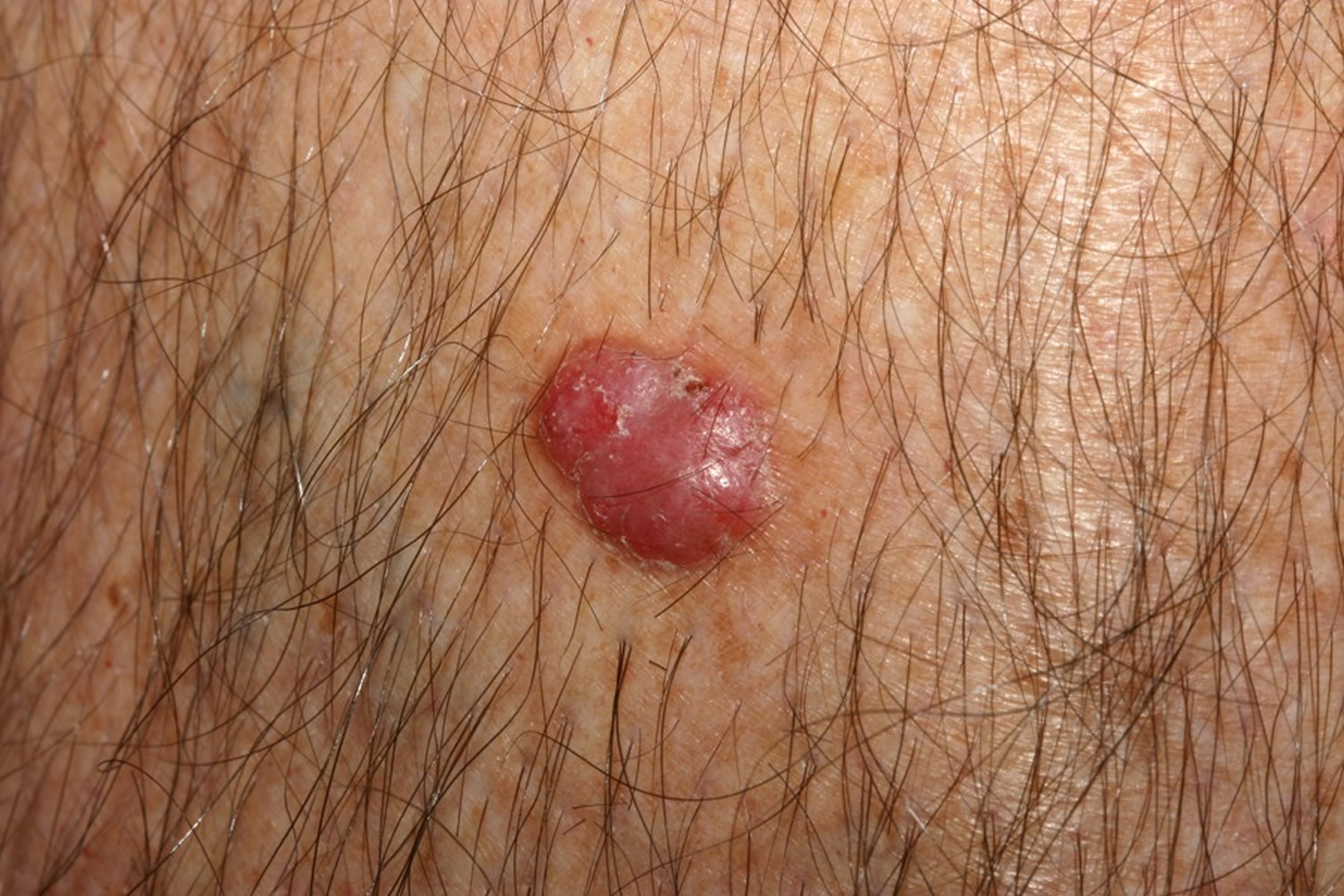 Basal Cell Carcinoma Causes Types Symptoms Prognosis Treatment