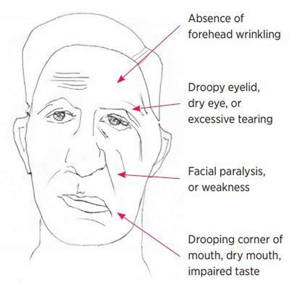 Bell S Palsy Causes Symptoms Diagnosis Recovery Treatment