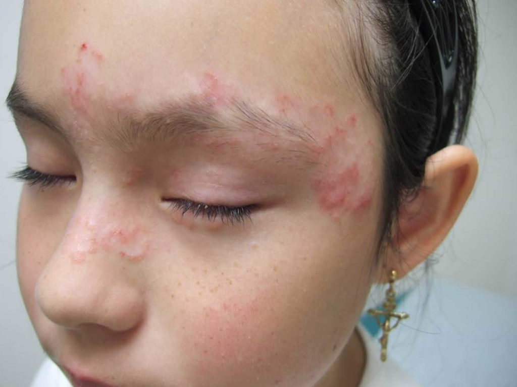 Pityriasis Rosea Causes Rash Herald Patch Stages Treatment