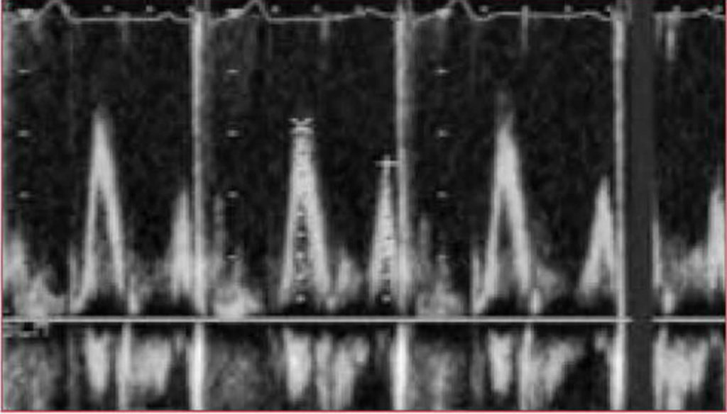 Echocardiogram Transesophageal Transthoracic Stress Echocardiogram