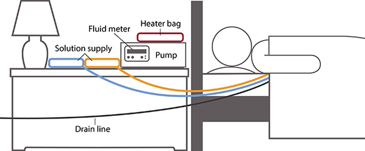 Hemodialysis Procedure Hemodialysis Side Effects