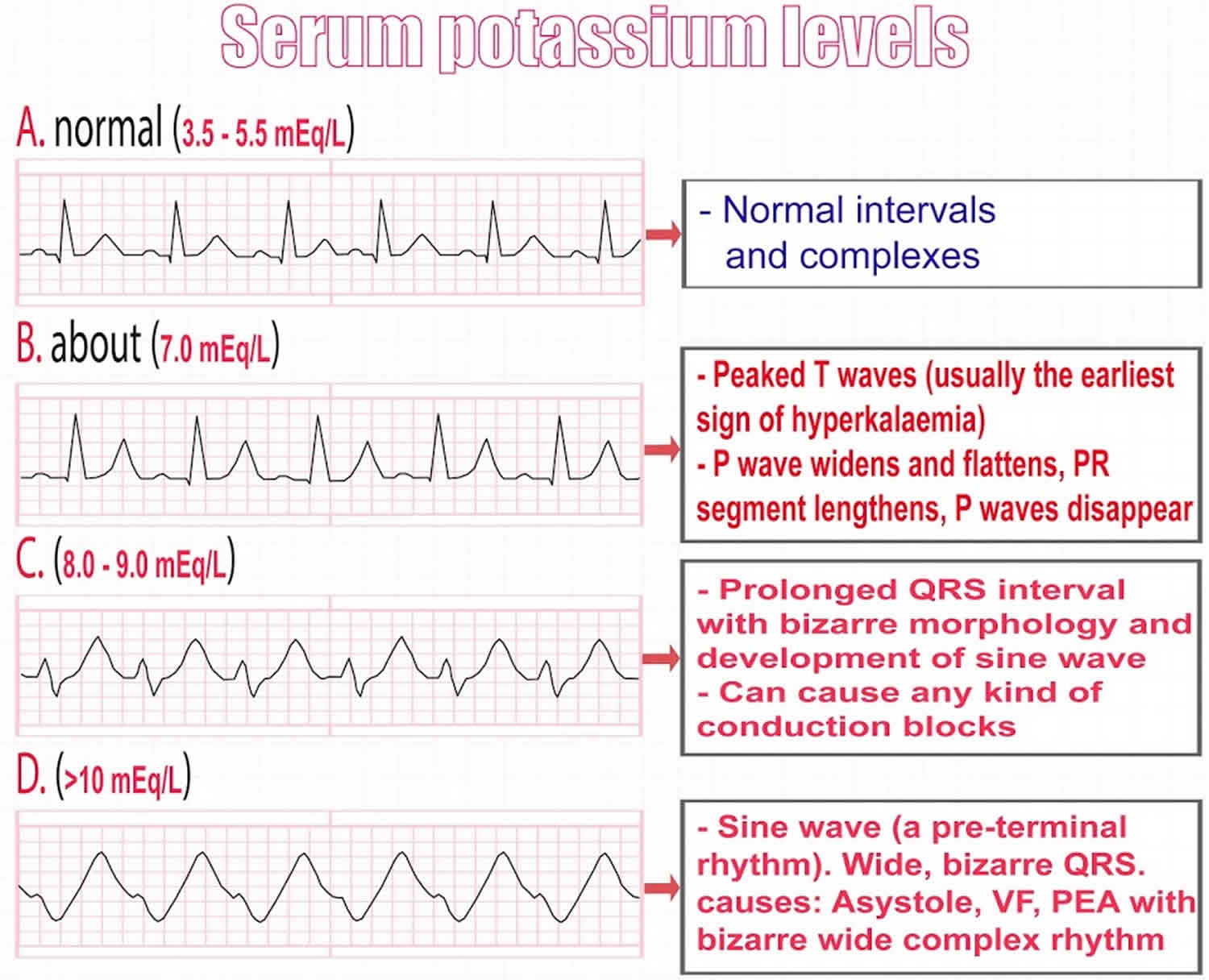 Hyperkalemia Causes Signs Symptoms Ecg Changes And Treatment