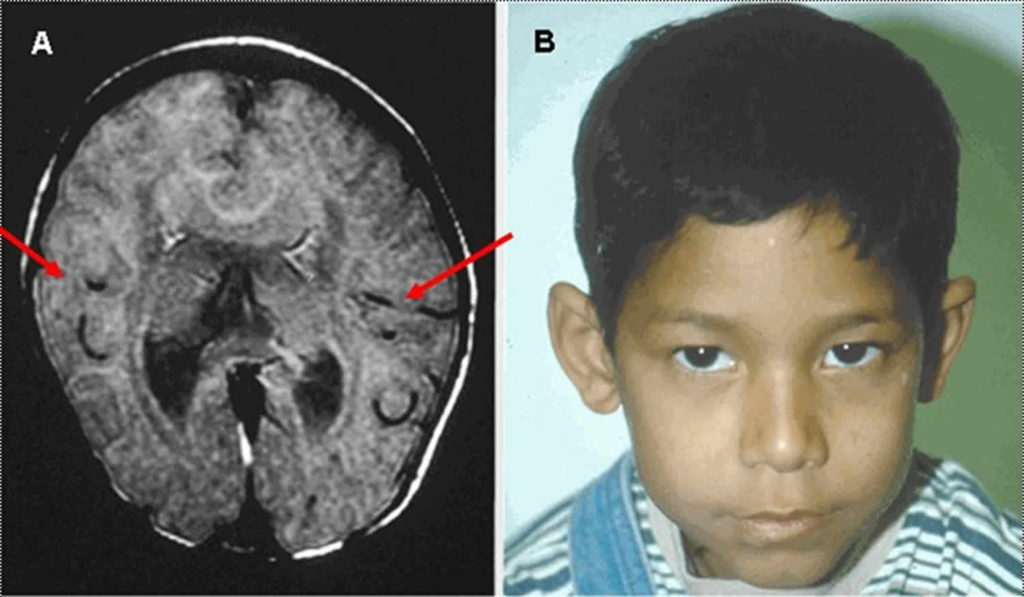 Holoprosencephaly Causes Diagnosis Prognosis And Treatment