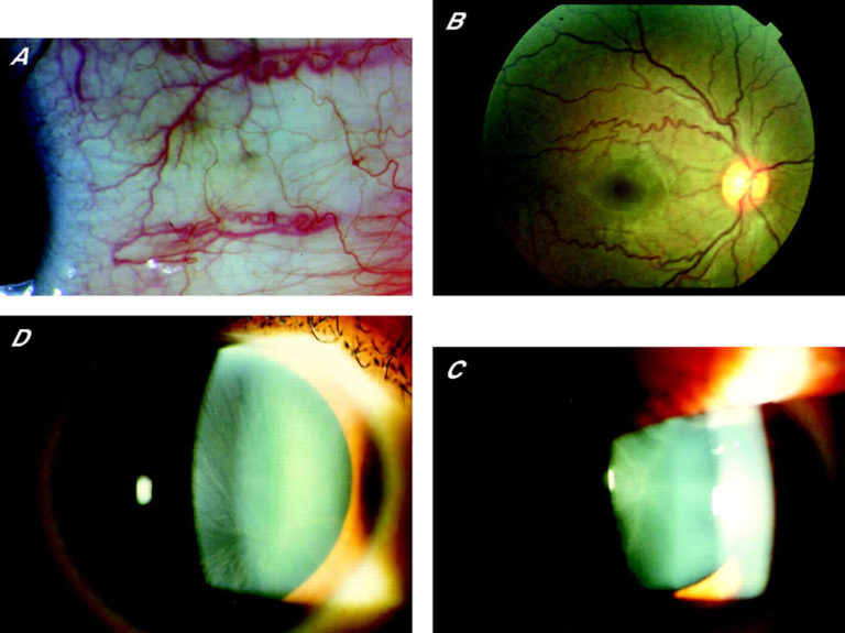 Fabry Disease Causes Symptoms Life Expectancy Diagnosis And Treatment