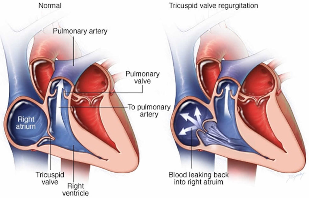 Tricuspid Valve Regurgitation Causes Severity Symptoms Diagnosis Treatment