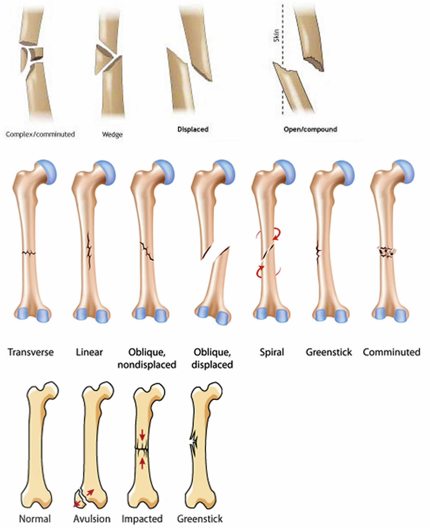Broken Femur Types Causes Treatment Recovery Time Complications
