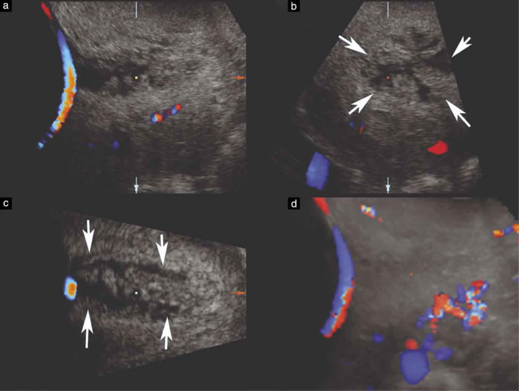 Vasa Previa Definition Causes Symptoms Diagnosis Ultrasound