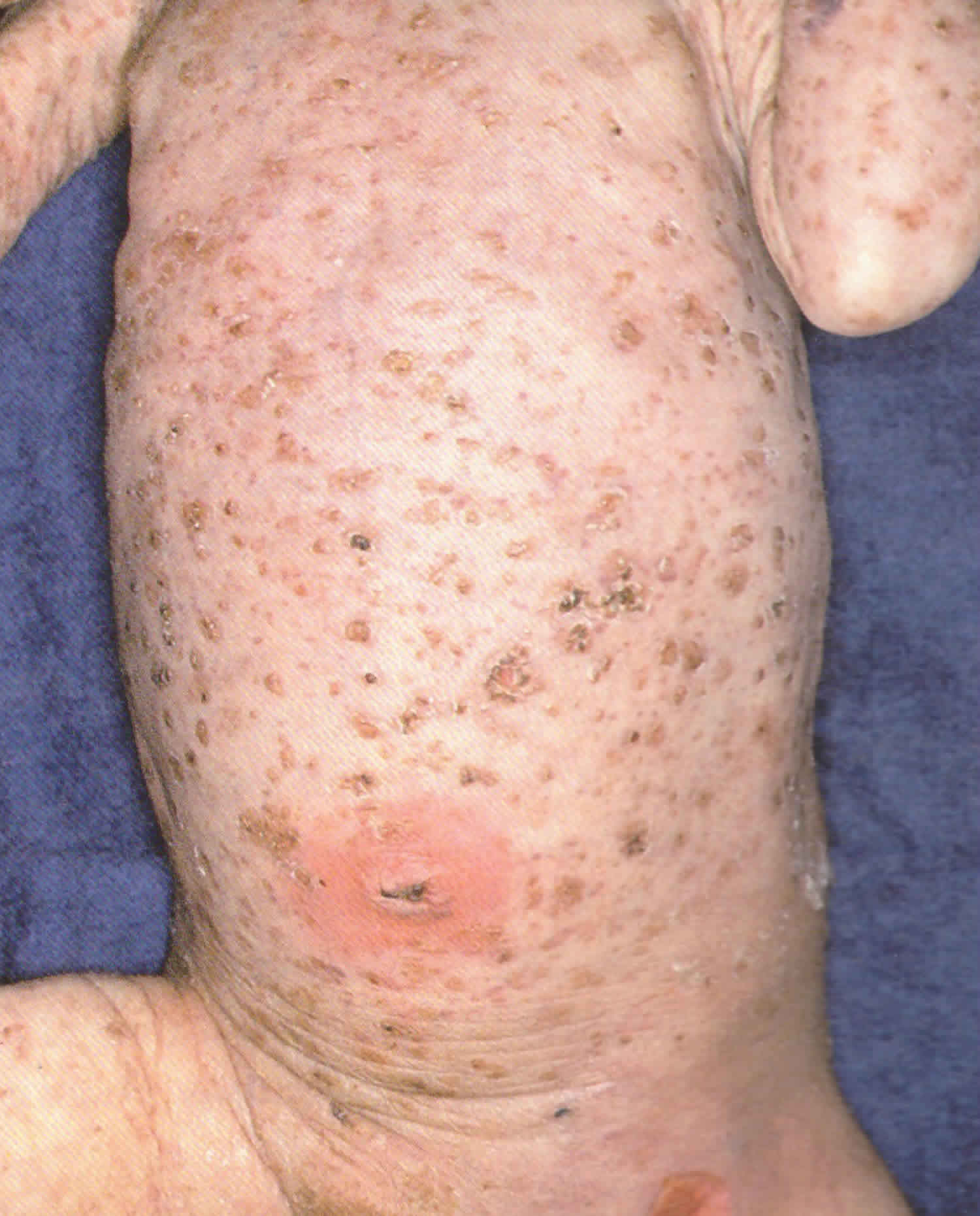Langerhans Cell Histiocytosis Causes Symptoms Diagnosis Treatment