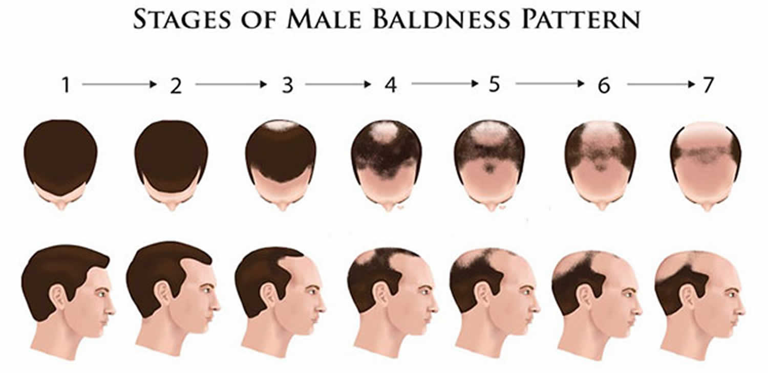 Signs Of Balding Male Hot Teenmodelz