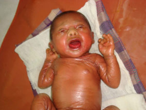 Lamellar Ichthyosis Causes Symptoms Diagnosis Treatment Prognosis