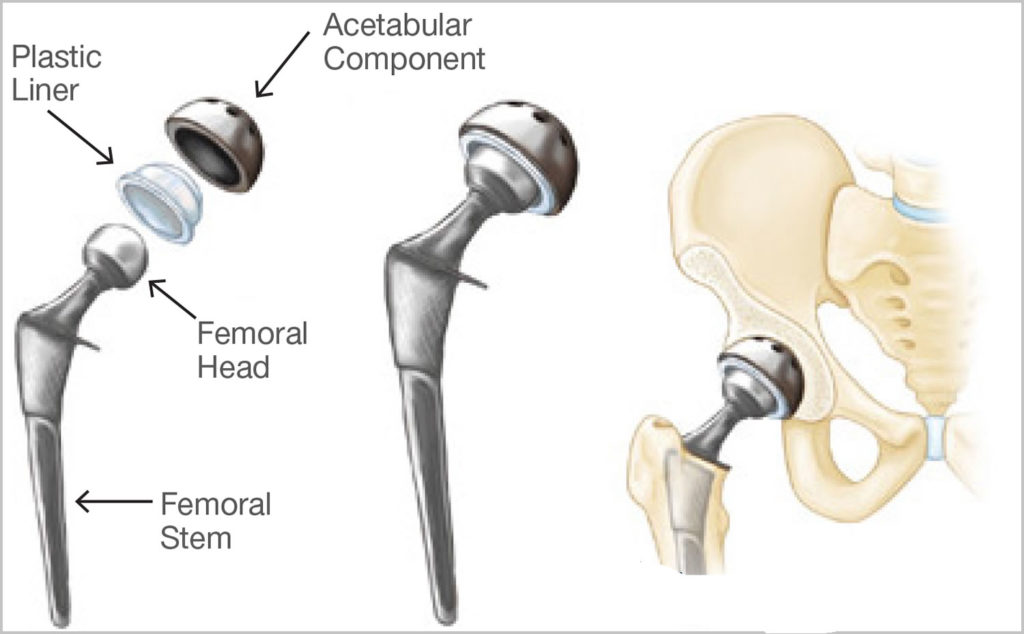 Osteonecrosis Hip Causes Stages Symptoms Diagnosis Treatment