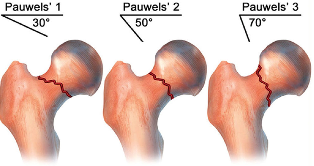 Femoral Neck Fracture Causes Types Symptoms Diagnosis Treatment Prognosis