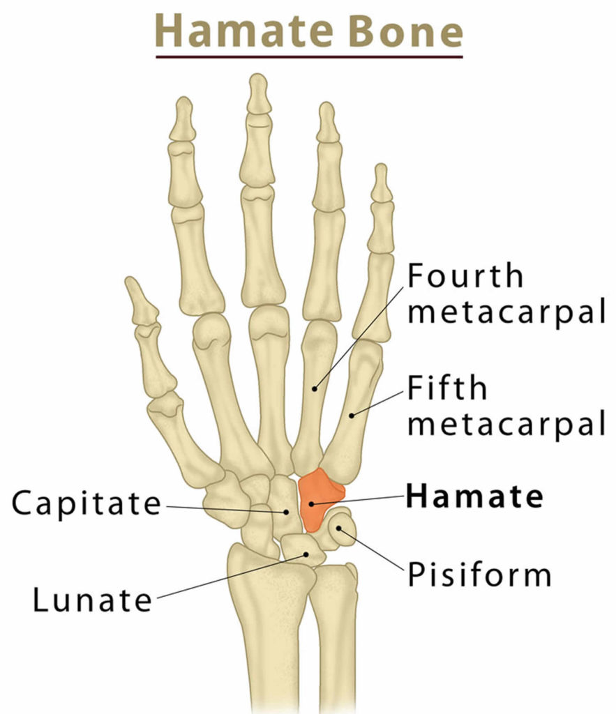 Hamate Fracture Causes Types Symptoms Diagnosis Treatment Prognosis