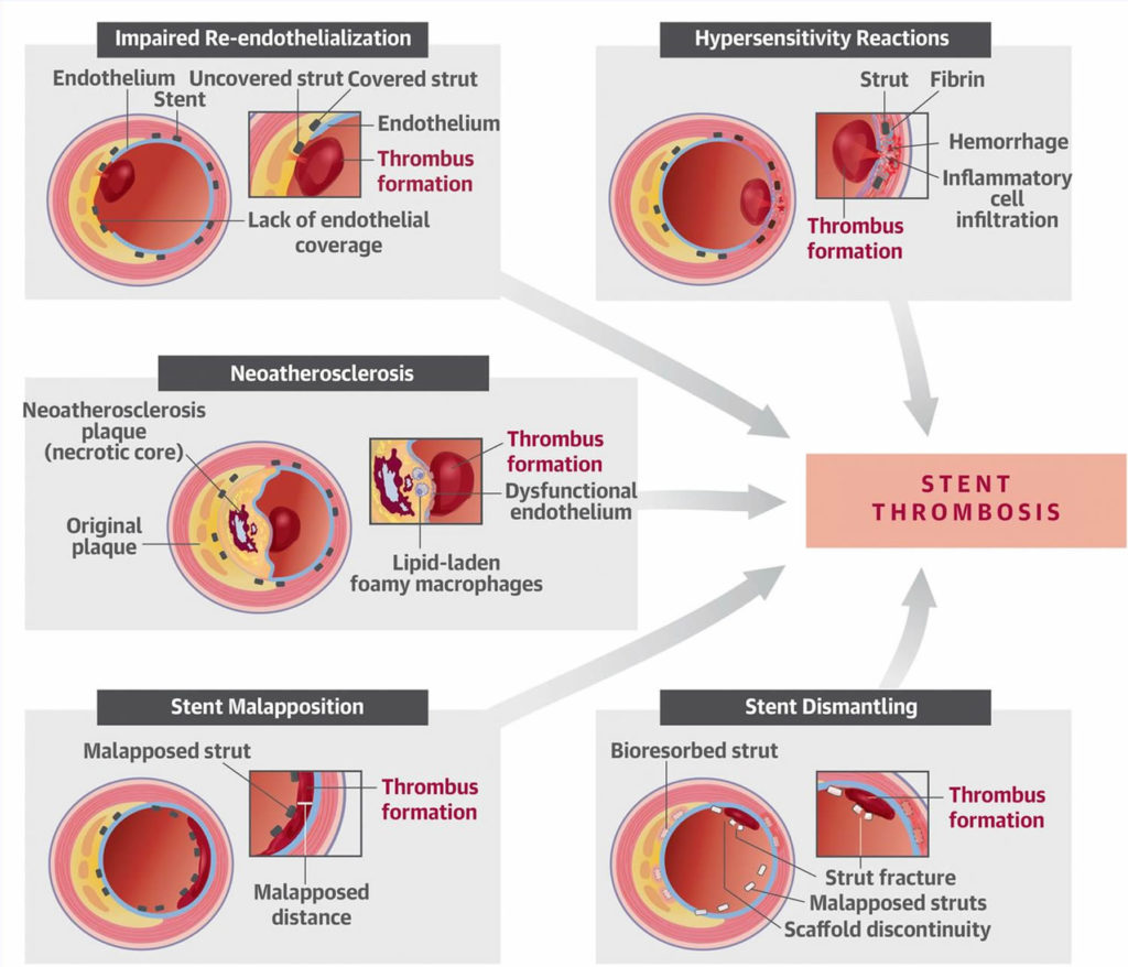 Restenosis In Stent Restenosis Causes Symptoms Diagnosis Treatment