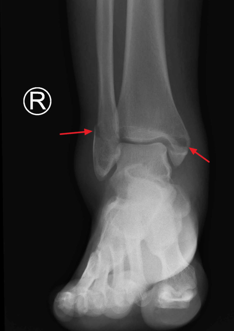 Bimalleolar Fracture Causes Symptoms Diagnosis Treatment Recovery