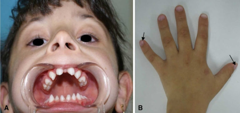 Hypohidrotic Ectodermal Dysplasia Causes Symptoms Diagnosis Treatment