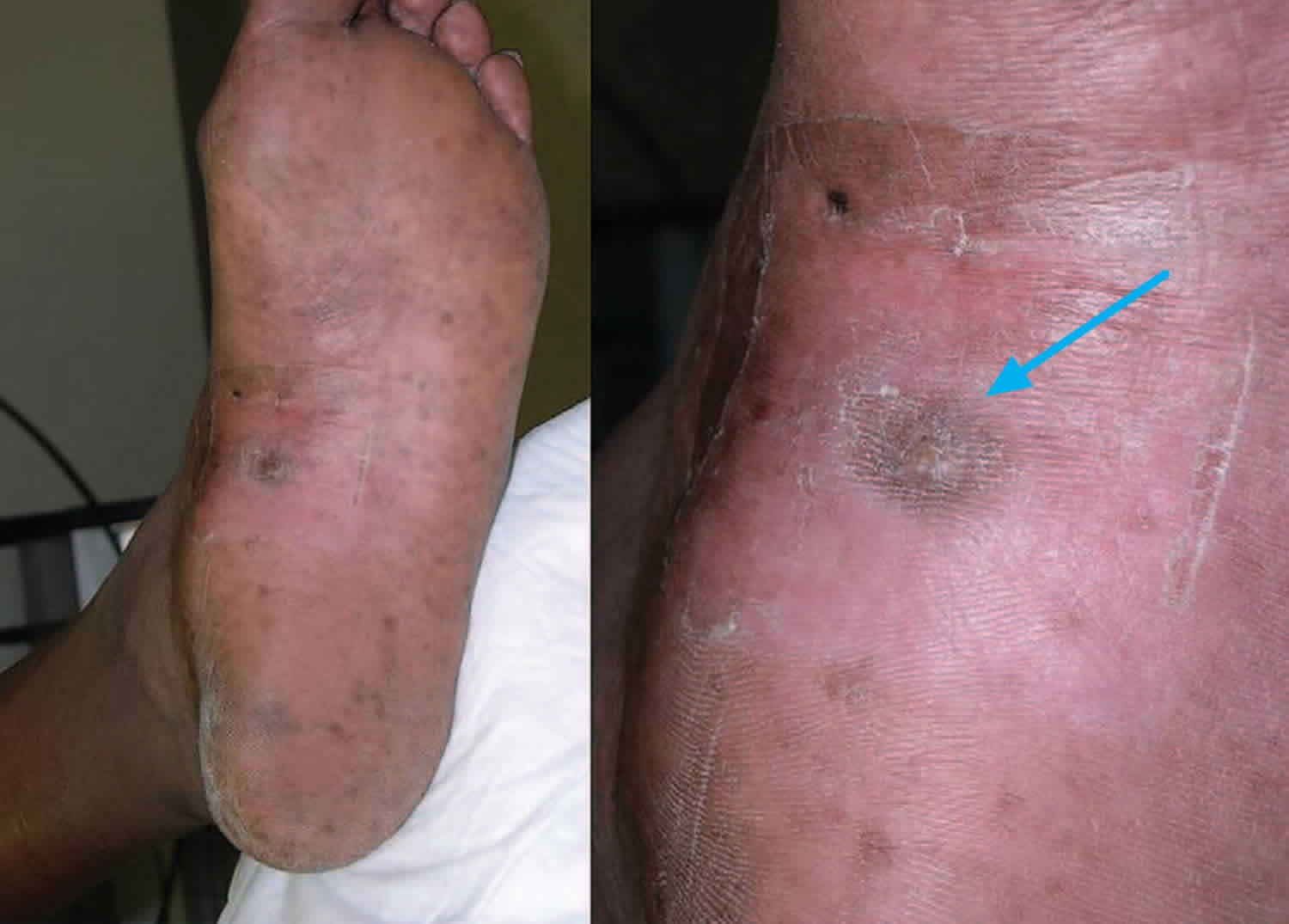 Epithelioid Angiosarcoma