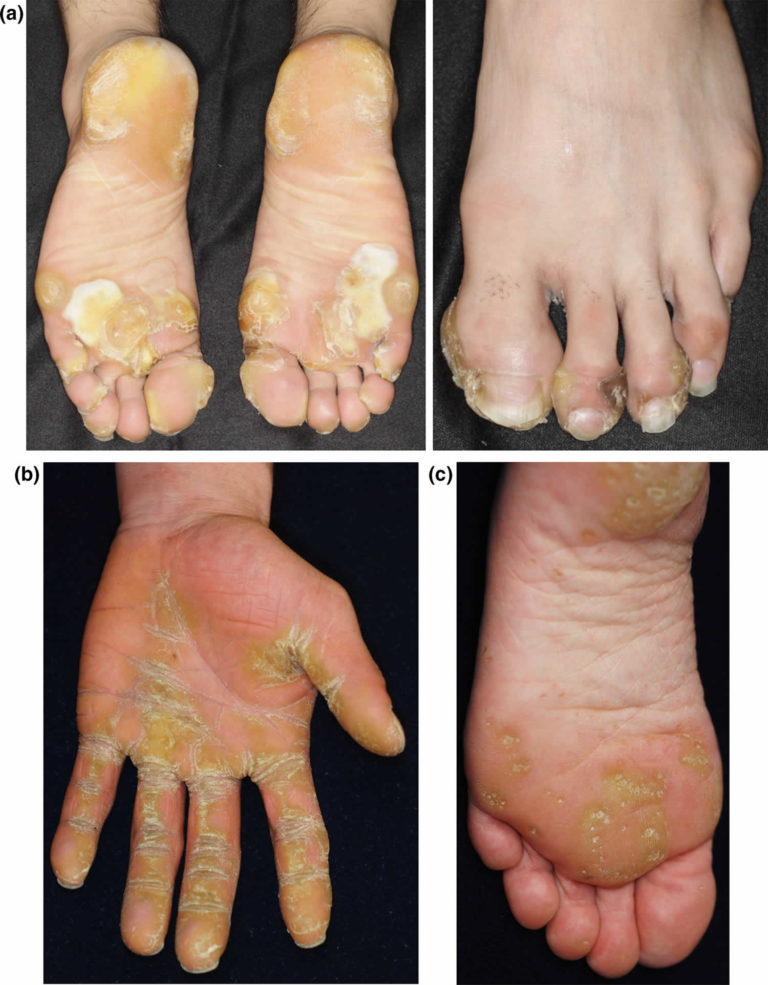 Palmoplantar Keratodermas Causes Symptoms Diagnosis Treatment