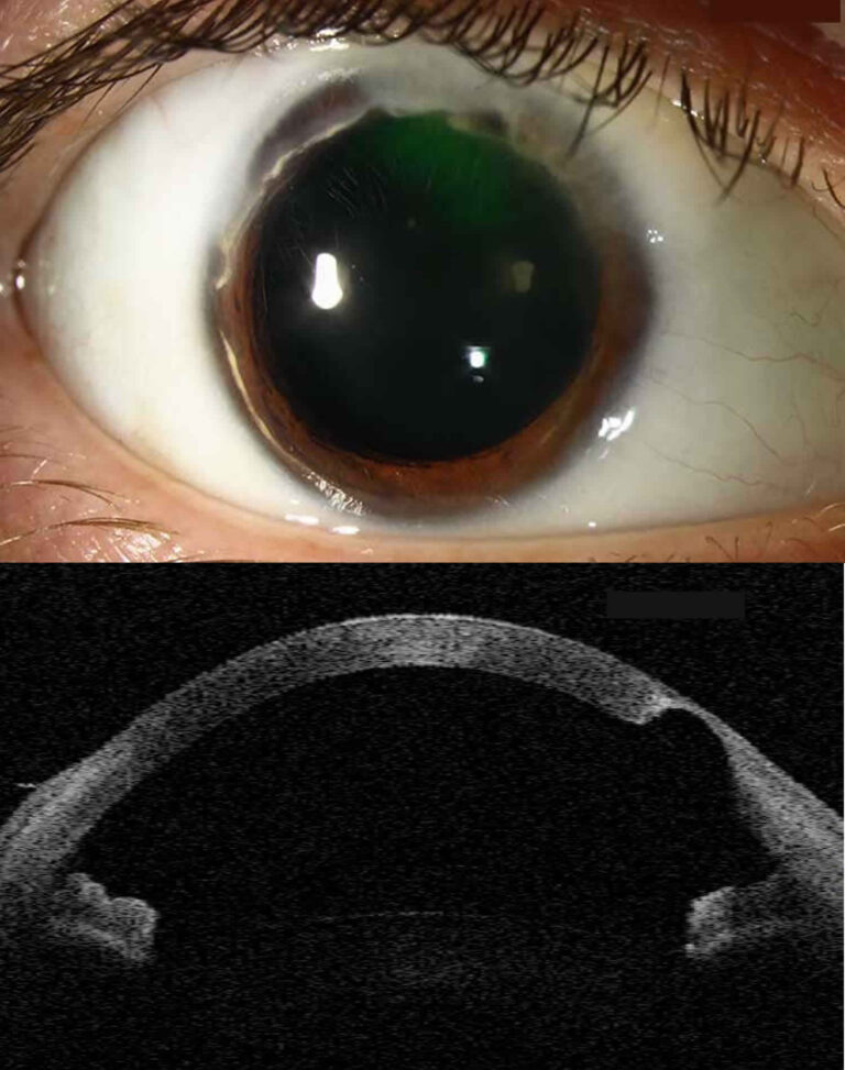 Terrien S Marginal Degeneration Causes Symptoms Diagnosis Treatment