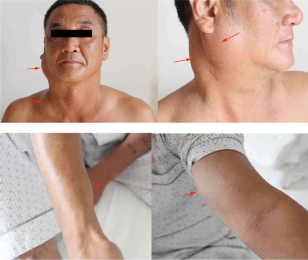 Kimura Disease Causes Symptoms Diagnosis Treatment Prognosis