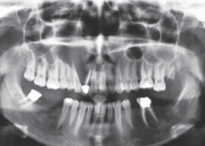 Odontogenic Keratocyst Definition Causes Symptoms Diagnosis