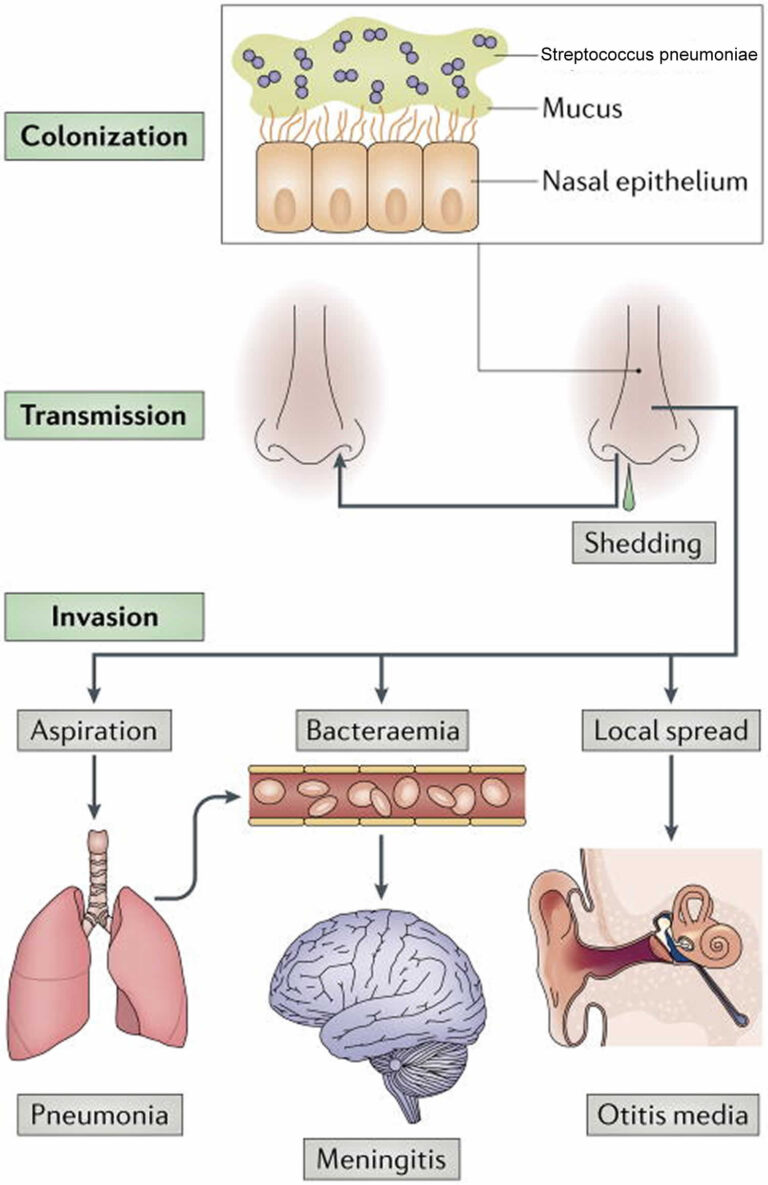 Streptococcus Pneumoniae Causes Prevention Diagnosis Treatment