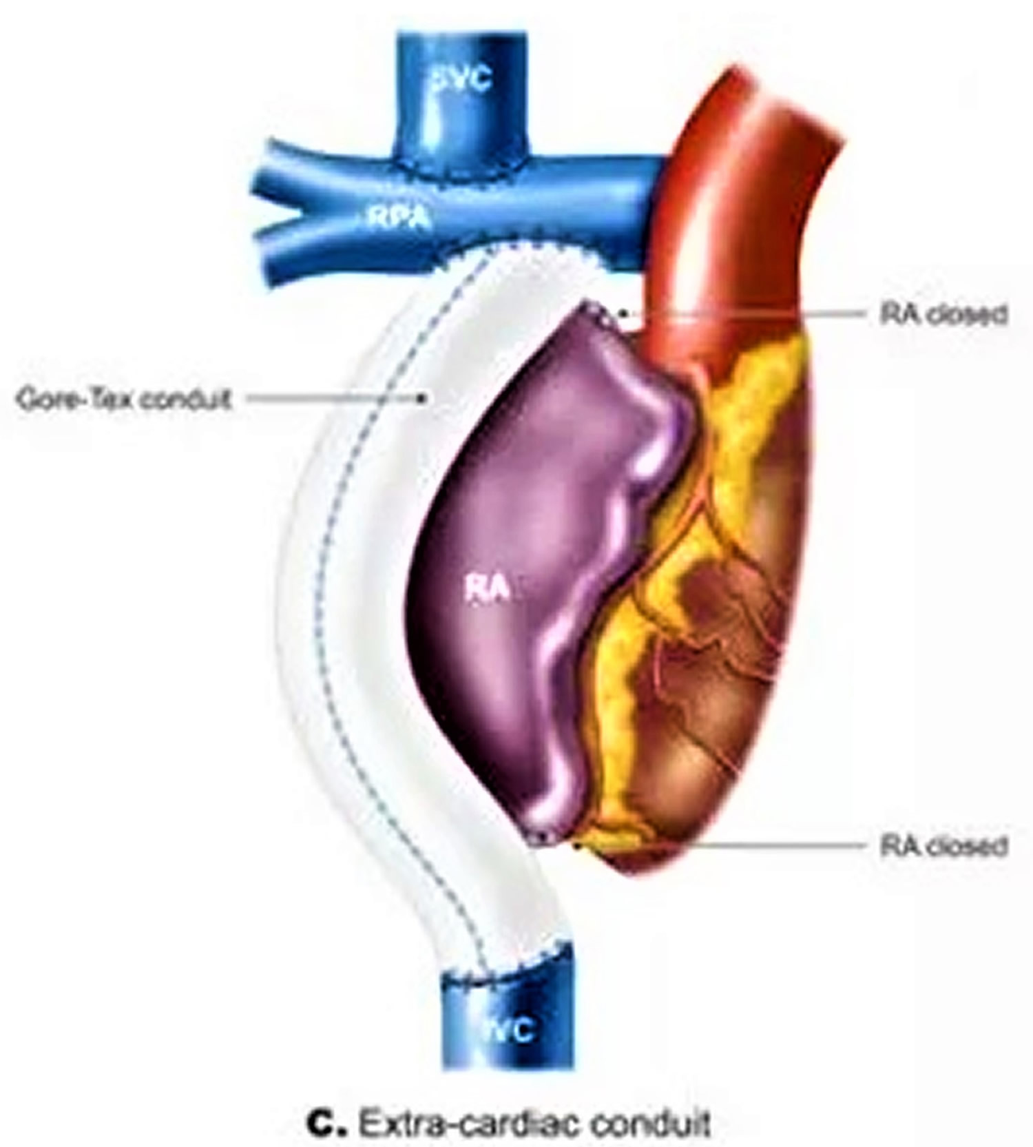 Fontan Procedure Uses Types Recovery Complications