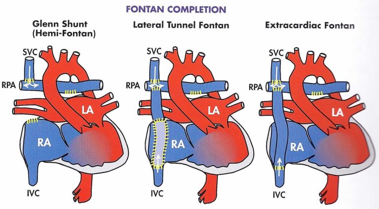 Fontan Procedure Uses Types Recovery Complications