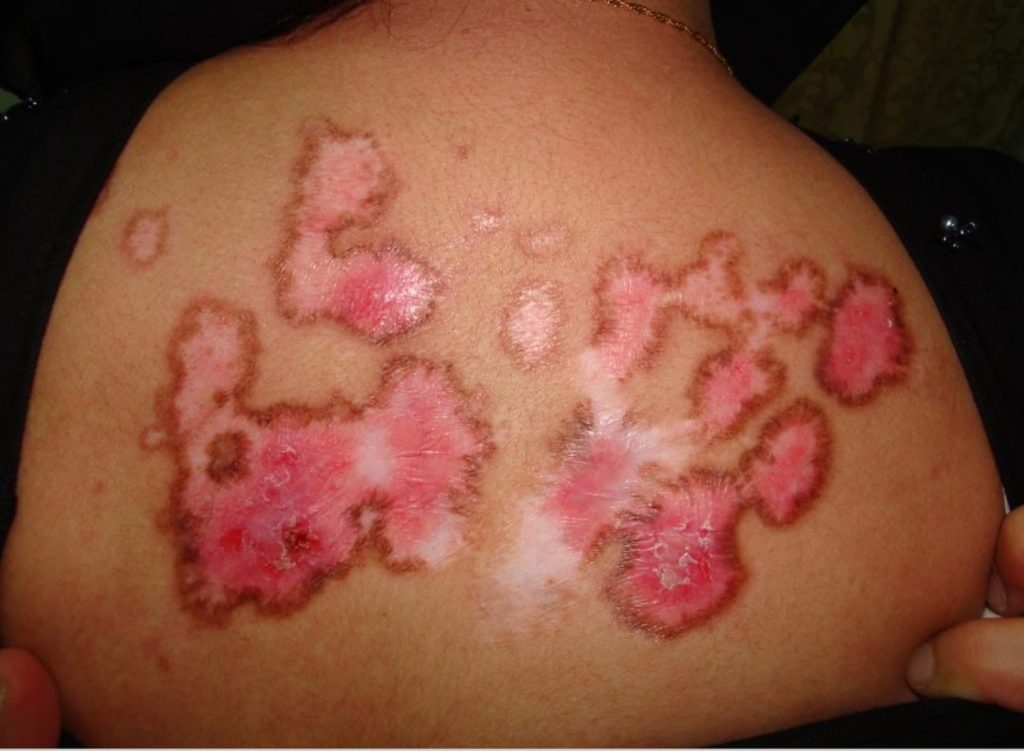 Systemic Lupus Erythematosus Causes Symptoms Diagnosis Treatment