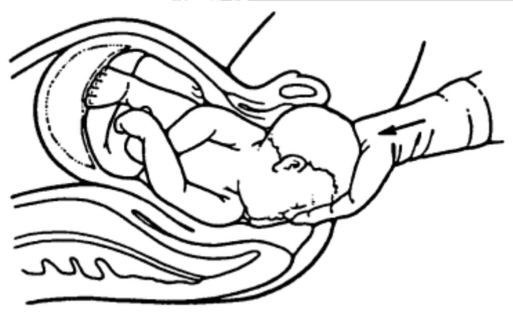 Shoulder Dystocia Causes Signs Diagnosis Treatment Maneuvers