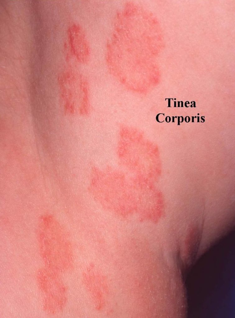 Ringworm Tinea Causes Signs Symptoms Diagnosis Treatment