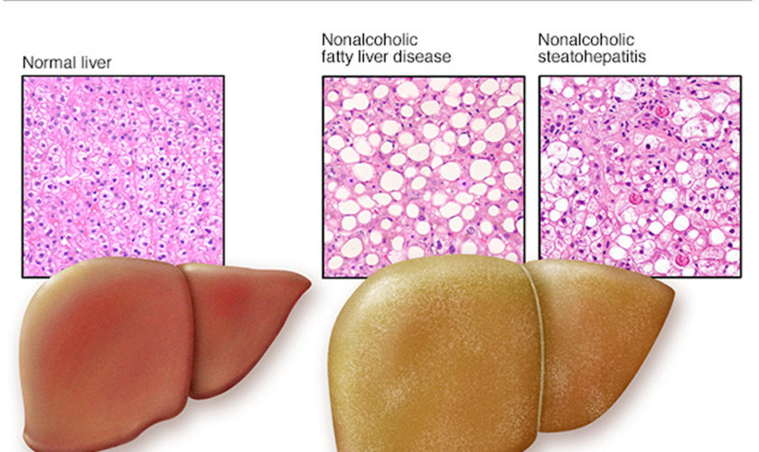 fatty liver and non-alcoholic fatty liver disease