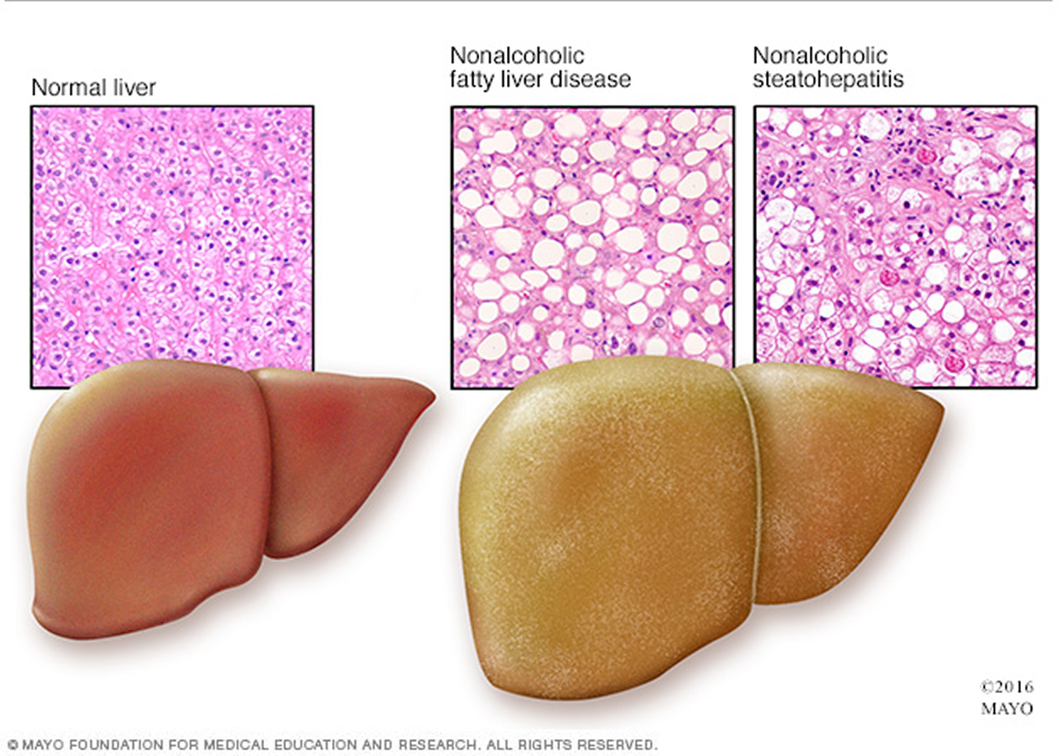 fatty liver and non-alcoholic fatty liver disease