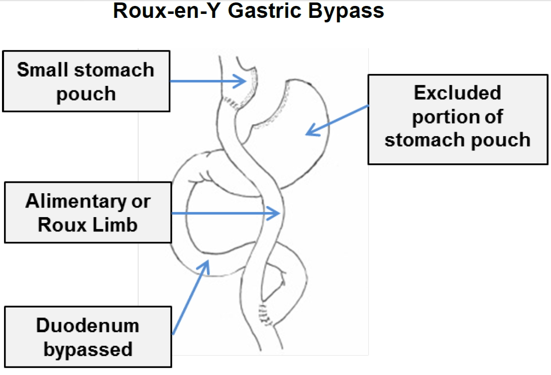 Gastric Bypass, Roux-en-Y Gastric Bypass, Indications, Side Effects ...