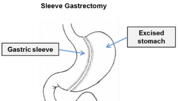 sleeve gastrectomy bariatric surgery