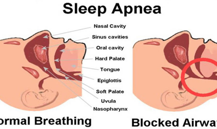 Sleep-Apnea-Causes