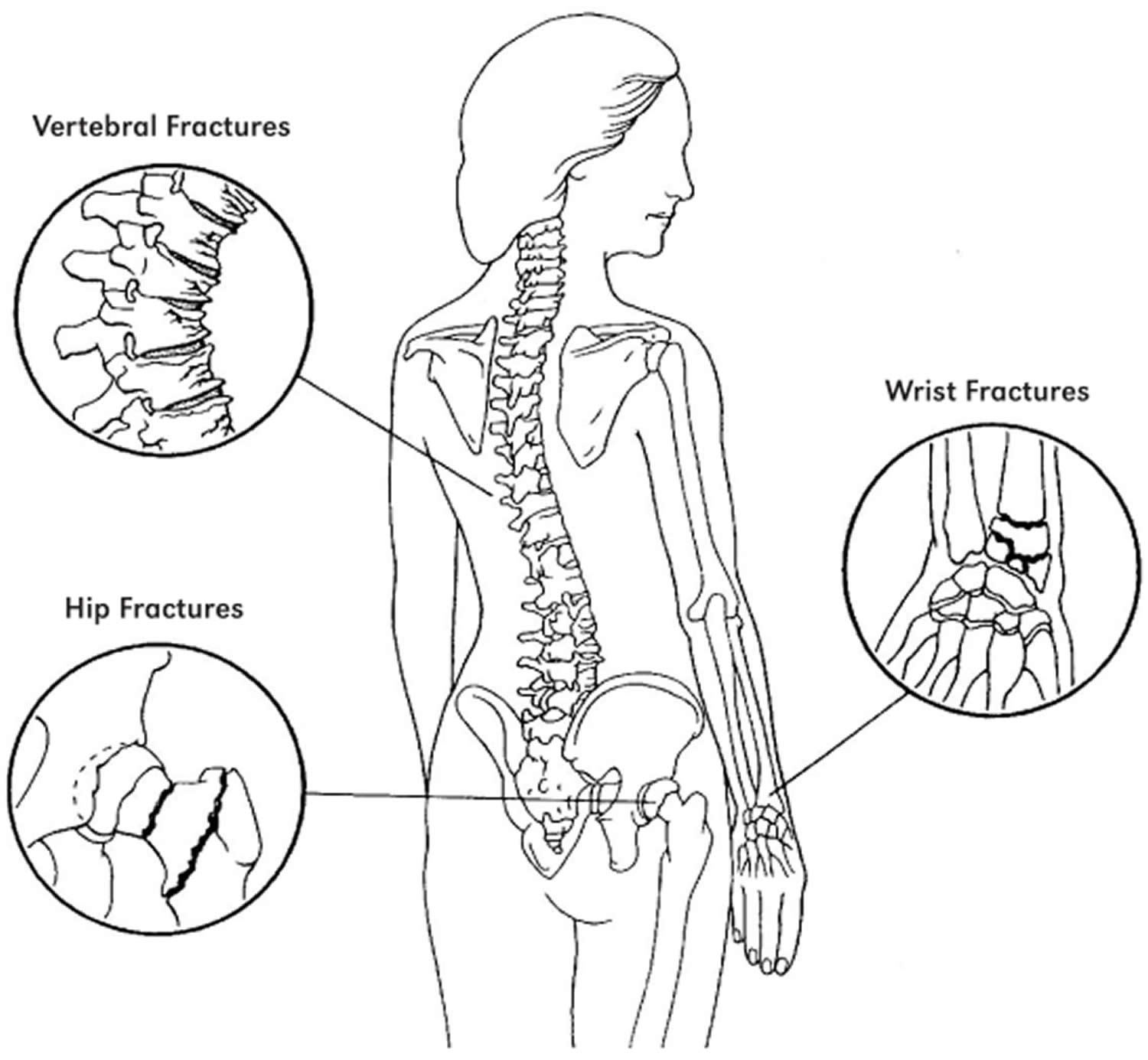 Common bone Fracture areas in osteoporosis
