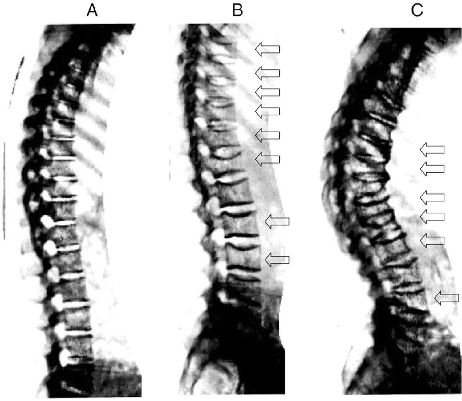 Spine x-rays showing severe compression fractures due to osteoporosis