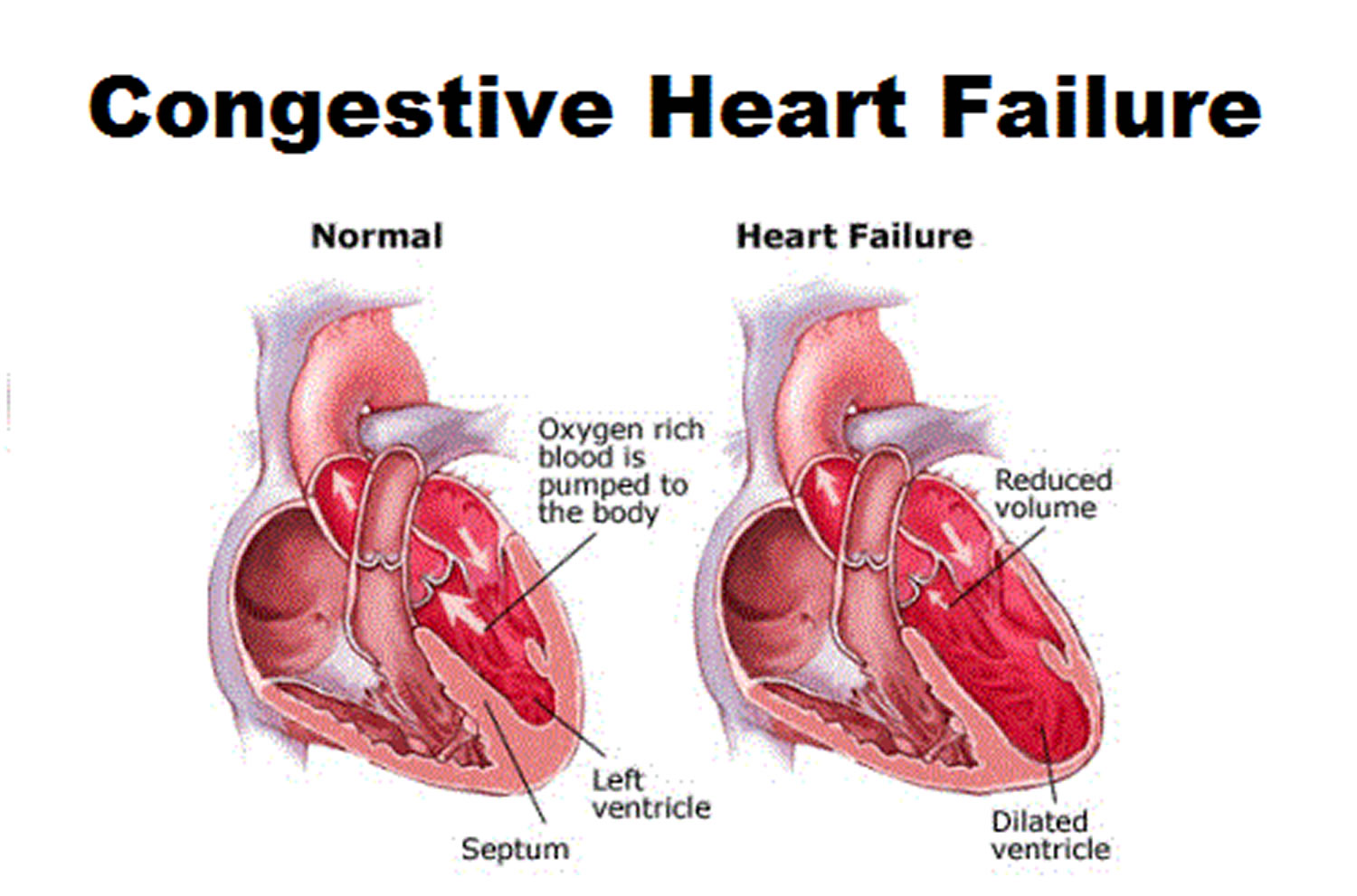 Сердечная недостаточность 30. Heart failure. Congestive Heart failure. Congestive Cardiac failure.