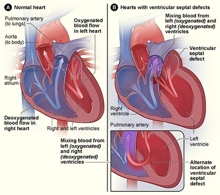 Eisenmenger Syndrome Causes, Diagnosis, Life Expectancy & Treatment