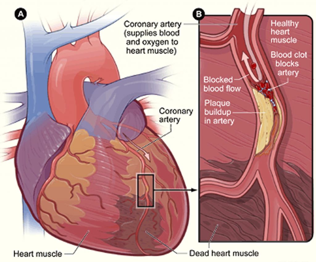 Unstable Angina Causes Symptoms Diagnosis Unstable Angina Treatment   Cause Of A Heart Attack 1024x847 