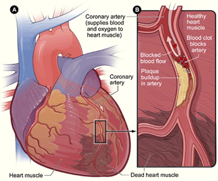 Esophageal Spasm Causes Symptoms Immediate Relief Treatment esophageal-spasm-causes-symptoms-immediate-relief-treatment