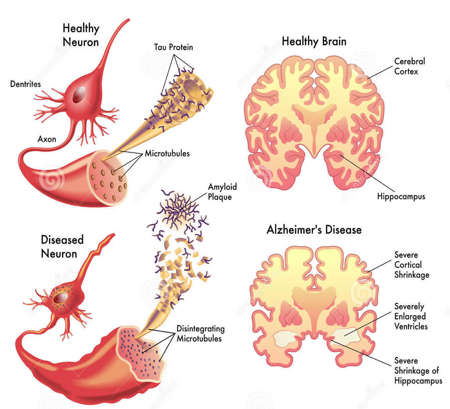 dementia stages