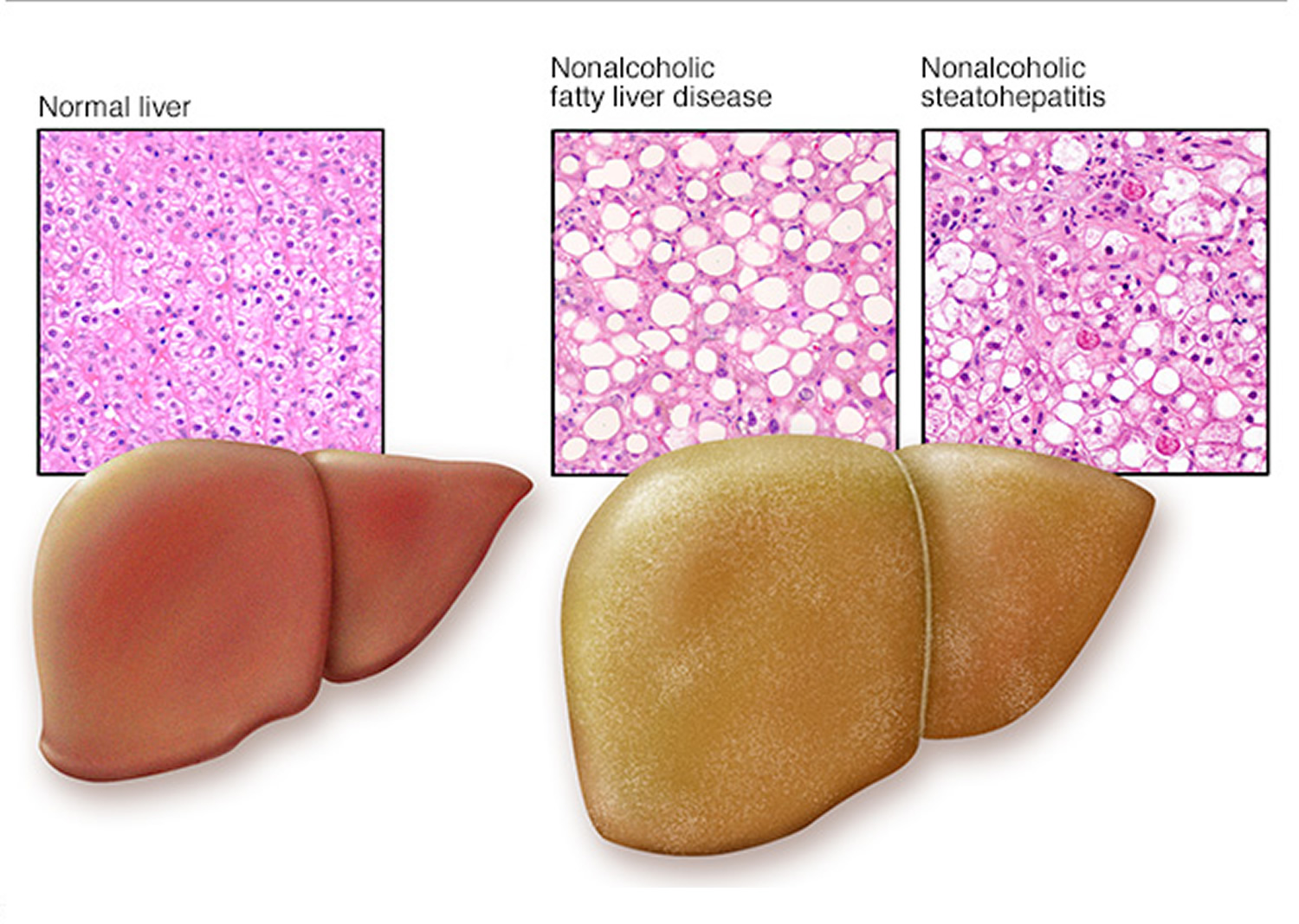 Fatty Liver Disease Nonalcoholic Causes Symptoms Treatments