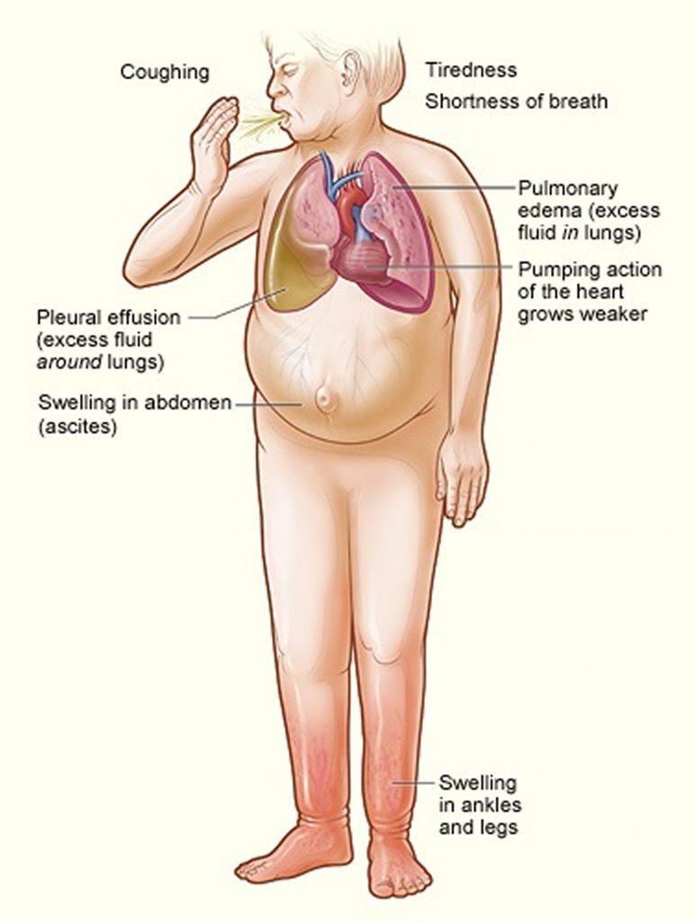 Can Fluid Overload Cause Congestive Heart Failure